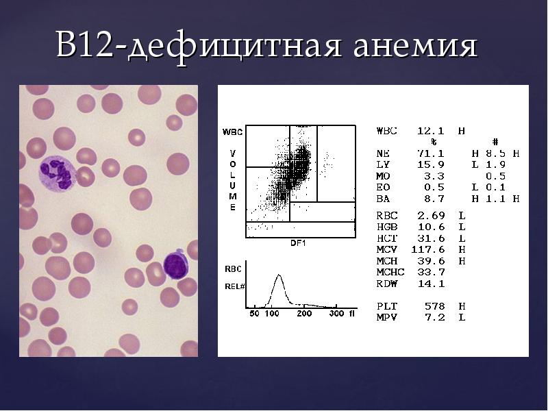 Б 12 исследования. Б12 анемия анализ крови показатели. ОАК при b12 анемии. B12 дефицитная анемия гемограмма. Показатели крови при в12 дефицитной анемии.
