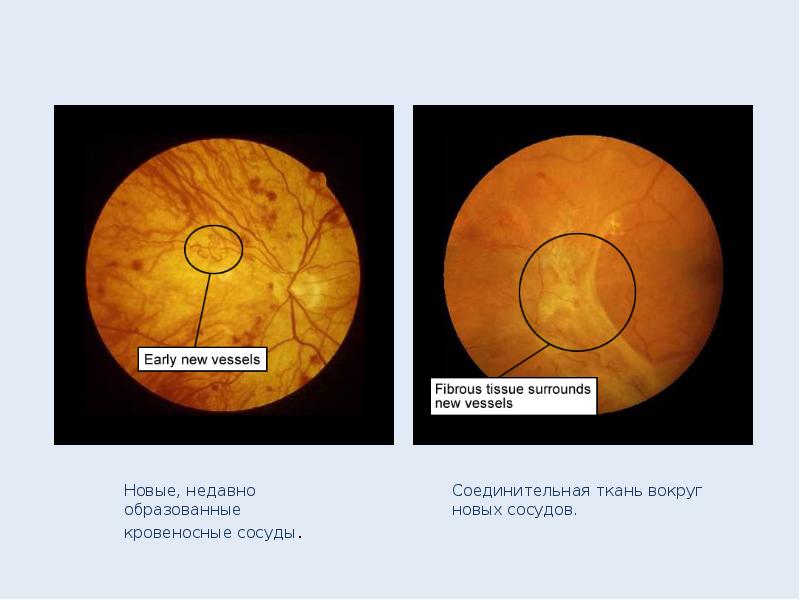 Изменения на глазном дне при сахарном диабете презентация