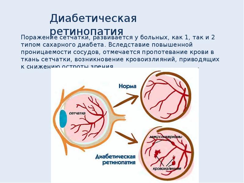 Изменения на глазном дне при сахарном диабете презентация