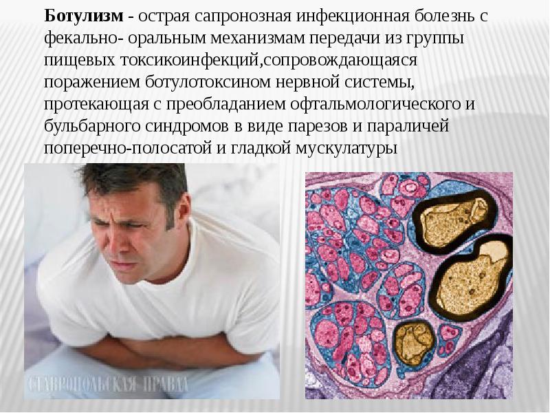 Характерный клинический симптом ботулизма. При ботулизме понос сменяется стойким запором через. При ботулизме понос сменяется стойким запором через. Острые инфекционные заболевания. При ботулизме понос сменяется стойким запором через.