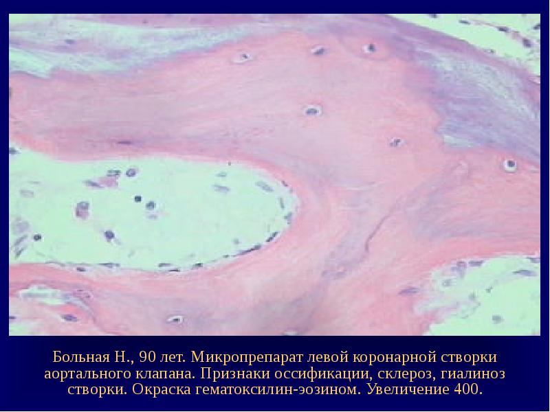 Гиалиноз плевры рисунок