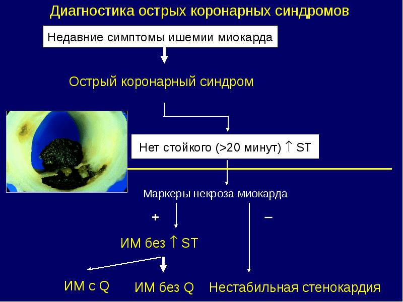 Острый коронарный синдром презентация