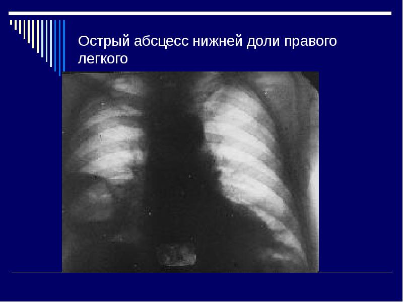 Гнойные заболевания легких и плевры презентация