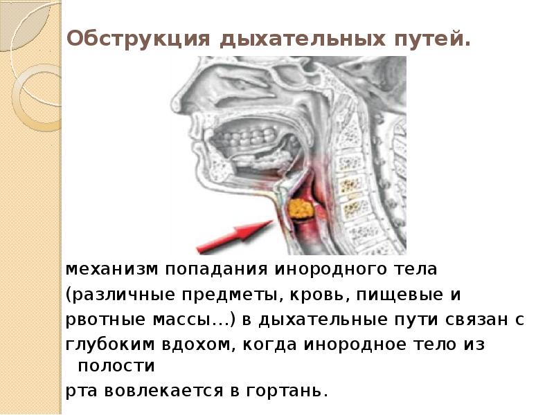 Полость проводить. Обструкция дыхательных путей. Обструкция дыхательных путей инородным телом. Обструкция гортани инородным телом. Механизм обструкции дыхательных путей.