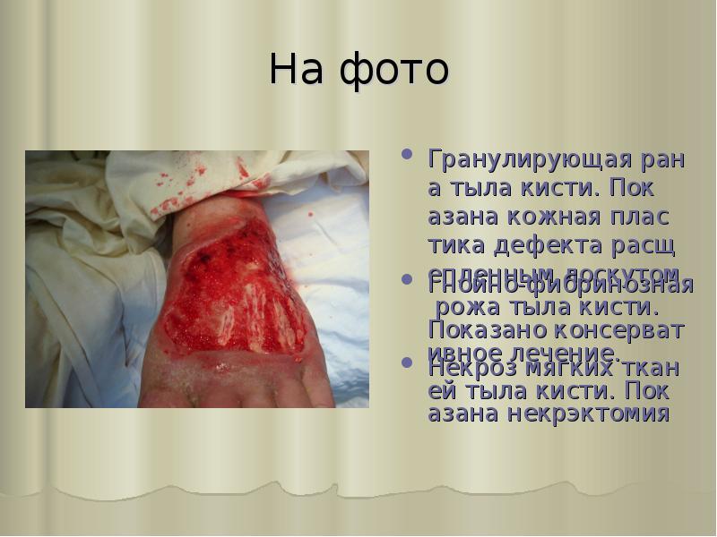 На фото
Гранулирующая рана тыла кисти. Показана кожная пластика дефекта расщепленным На фото
Гранулирующая рана тыла кисти. Показана кожная пластика дефекта расщепленным