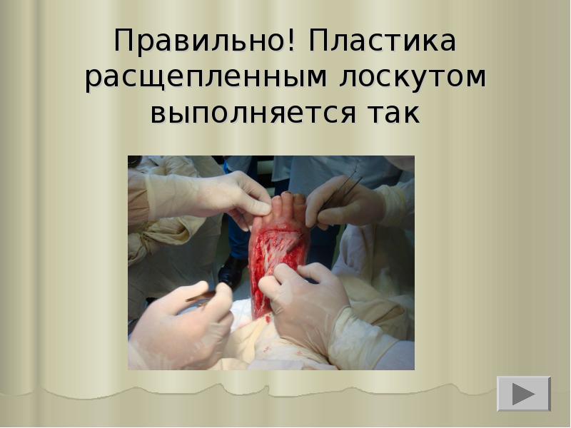 Правильно! Пластика расщепленным лоскутом выполняется так Правильно! Пластика расщепленным лоскутом выполняется так