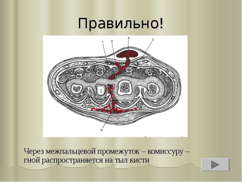 Правильно!
Через межпальцевой промежуток – комиссуру – гной распространяется на тыл Правильно!
Через межпальцевой промежуток – комиссуру – гной распространяется на тыл