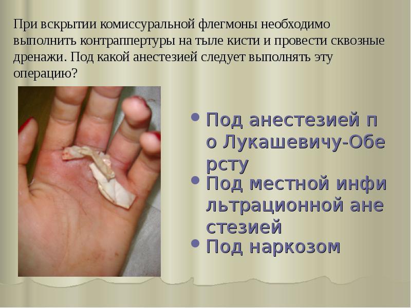 При вскрытии комиссуральной флегмоны необходимо выполнить контраппертуры на тыле кисти и При вскрытии комиссуральной флегмоны необходимо выполнить контраппертуры на тыле кисти и