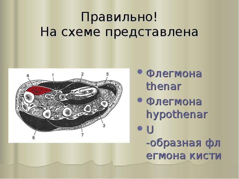 Правильно! На схеме представлена
Флегмона thenar
Флегмона hypothenar
U-образная флегмона кисти Правильно! На схеме представлена
Флегмона thenar
Флегмона hypothenar
U-образная флегмона кисти