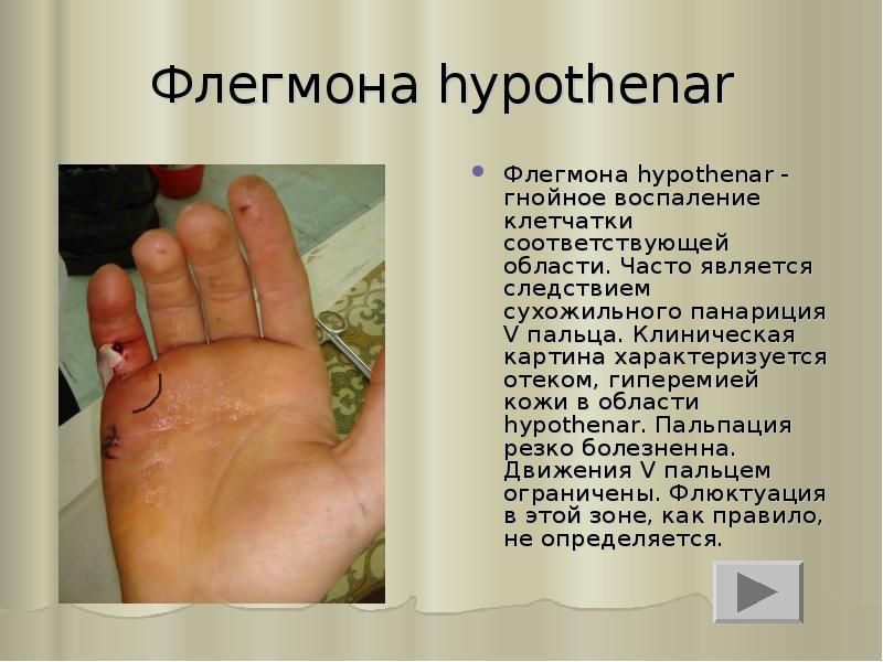 Флегмона hypothenar
Флегмона hypothenar - гнойное воспаление клетчатки соответствующей области. Часто Флегмона hypothenar
Флегмона hypothenar - гнойное воспаление клетчатки соответствующей области. Часто