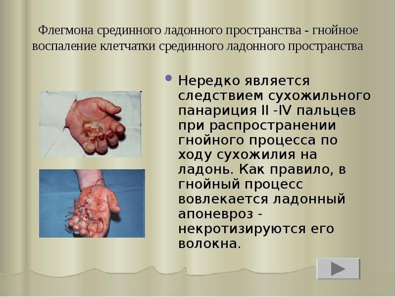 Флегмона срединного ладонного пространства - гнойное воспаление клетчатки срединного ладонного пространства
Флегмона срединного ладонного пространства - гнойное воспаление клетчатки срединного ладонного пространства