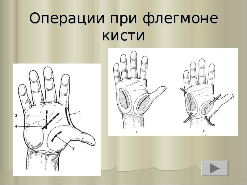 Операции при флегмоне кисти Операции при флегмоне кисти