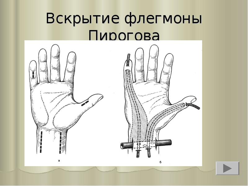 Вскрытие флегмоны Пирогова Вскрытие флегмоны Пирогова