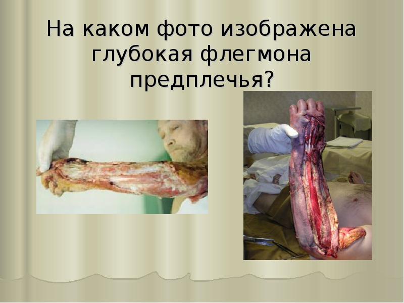 На каком фото изображена глубокая флегмона предплечья? На каком фото изображена глубокая флегмона предплечья?