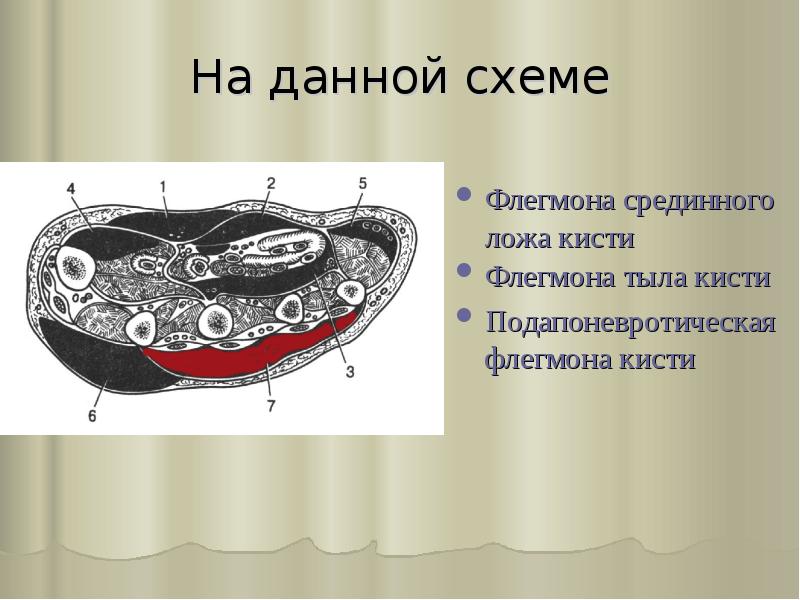 На данной схеме
Флегмона срединного ложа кисти
Флегмона тыла кисти
Подапоневротическая На данной схеме
Флегмона срединного ложа кисти
Флегмона тыла кисти
Подапоневротическая