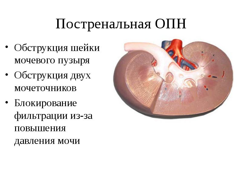 Острая почечная недостаточность картинки