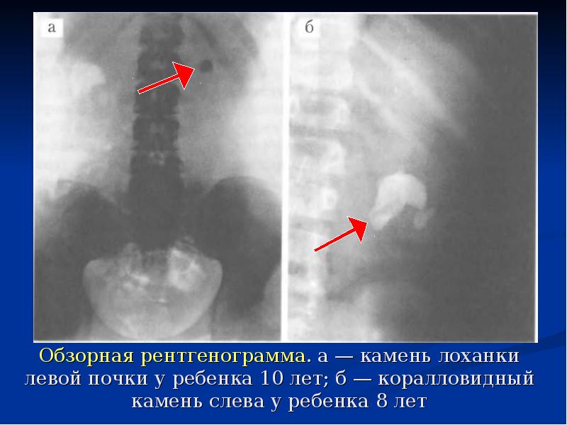 Мочекаменная болезнь урология презентация