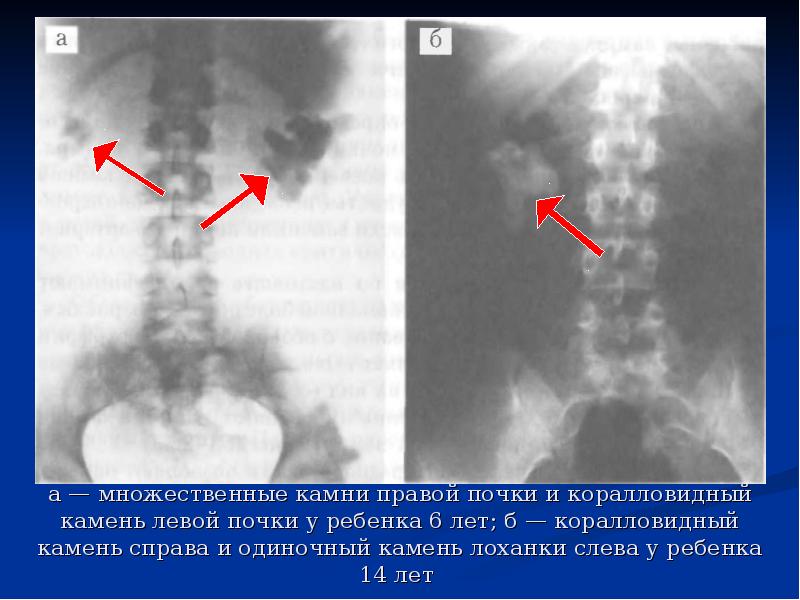 Конкременты лоханки. Конкремент почки рентген. Мочекаменная болезнь коралловидные камни. Обзорная рентгенография почек коралловидный камень. Коралловидный камень в почке рентген.