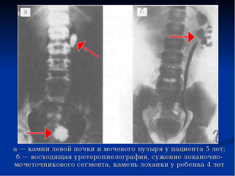 Что делать если камень застрял в мочеточнике