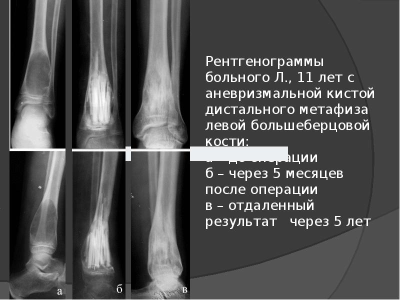 Костные кисты презентация