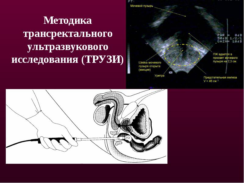 Трузи микролаксом