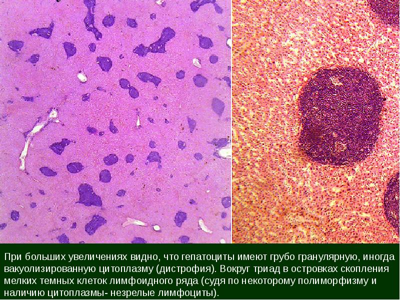 дистрофия цитоплазмы