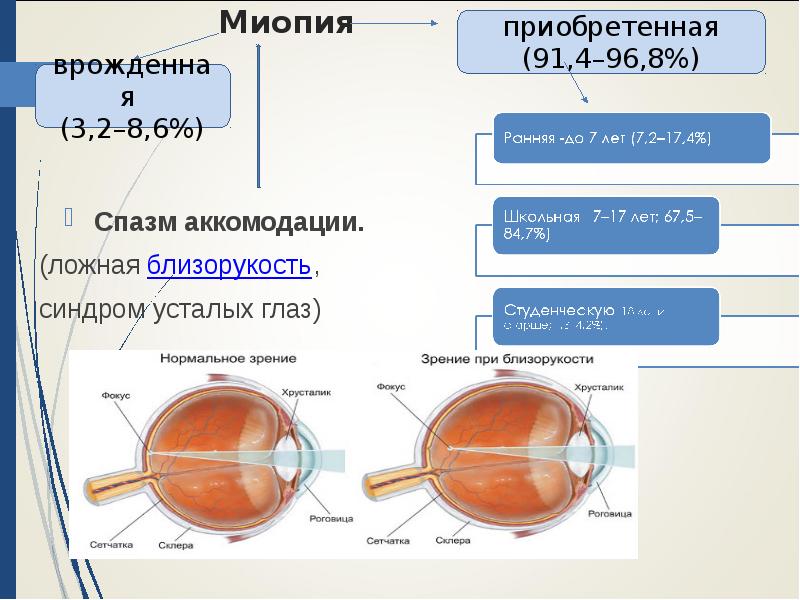 Миопия при беременности презентация