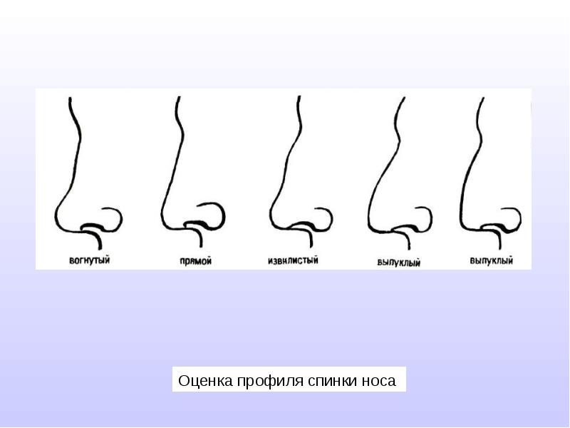 Оценка профиля. Извилистый контур спинки носа. Форма спинки носа. Прямая, вогнутая, выпуклая, Извилистая.. Вогнутая или Извилистая спинка носа.. Профиль оценки.