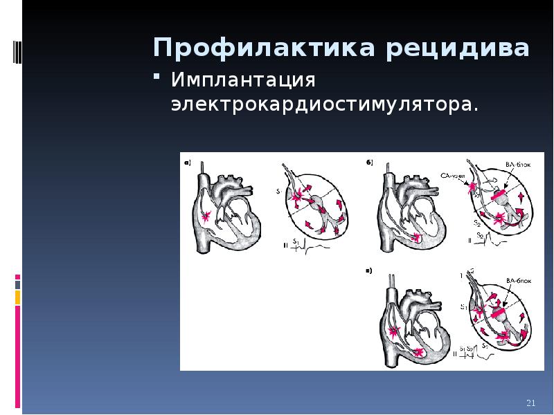 Синдром внезапной сердечной смерти презентации