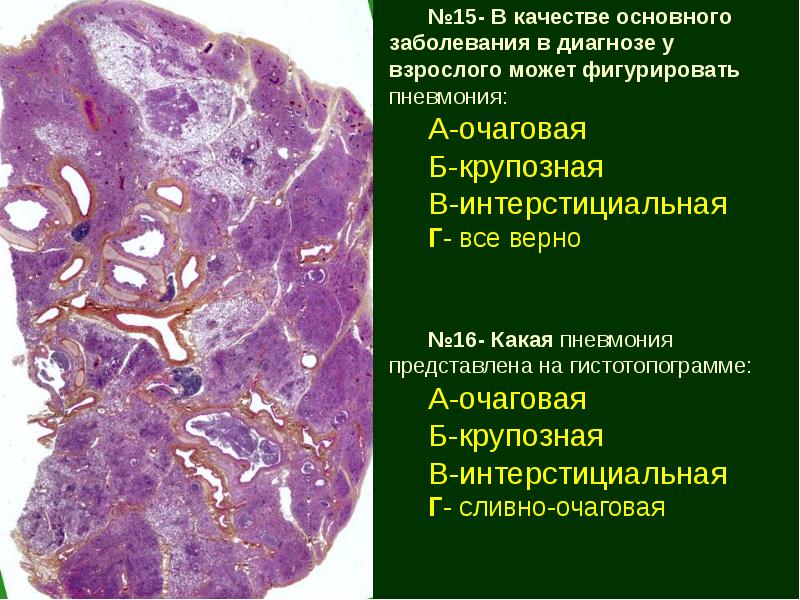 Крупозная пневмония патологическая анатомия презентация