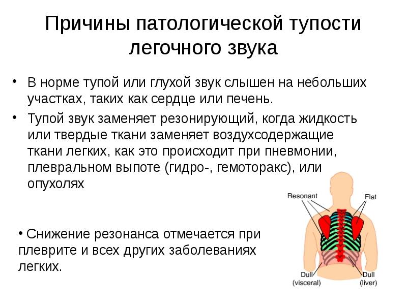 Причины патологической тупости легочного звука  В норме тупой или глухой