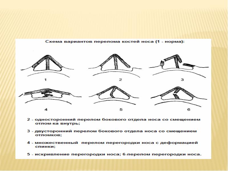 Ушиб носа карта вызова