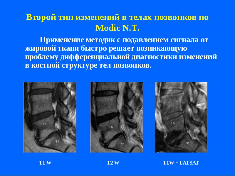 Жировая дегенерация позвоночника