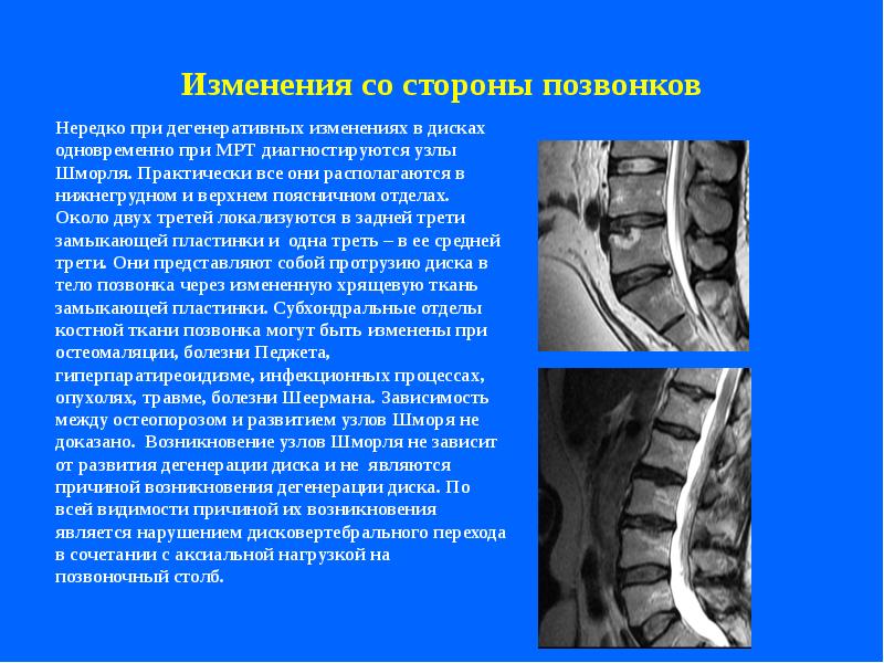 Мр картина дегенеративно дистрофических изменений пояснично крестцового отдела позвоночника и армия