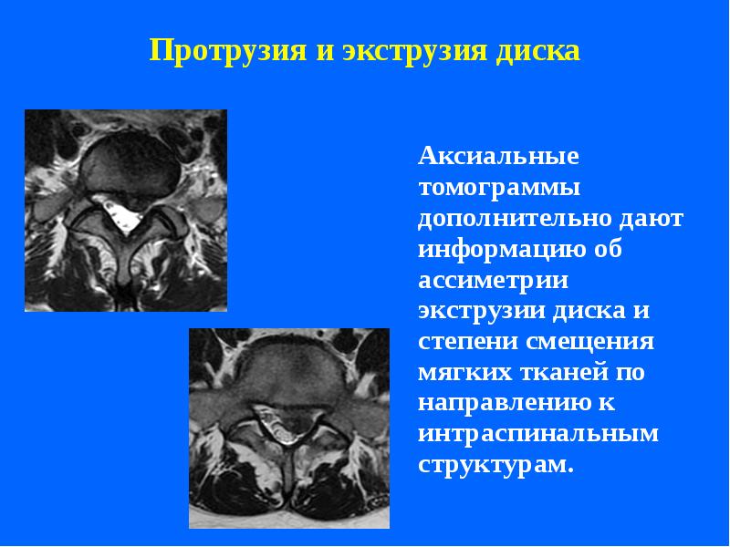 Экструзия диска. Протрузия экструзия. Экструзия и протрузия дисков. Протрузии и экструзии.