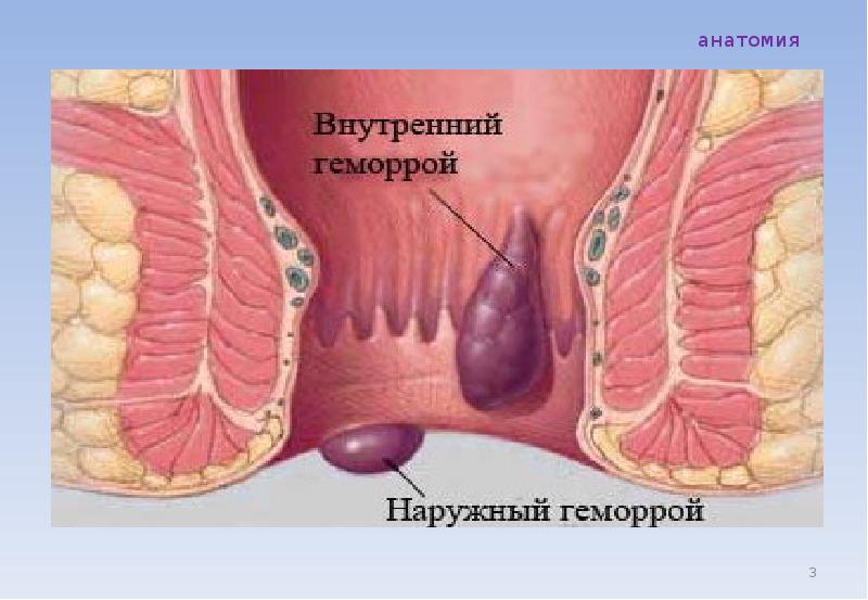 Геморрой картинки прикольные картинки