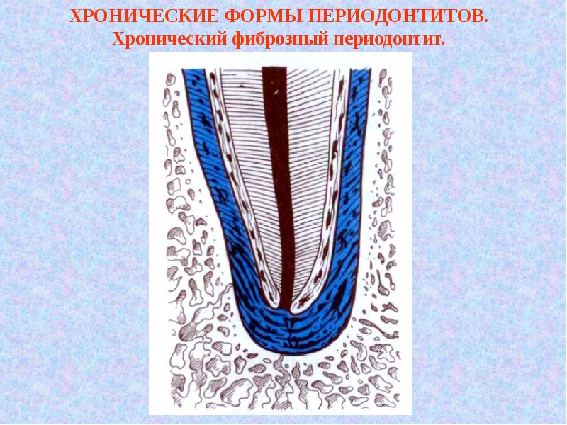 Хронический фиброзный периодонтит лечение. Хронический фиброзный периодонтит. Хронический фиброзный пародонтит. Хронич фиброзный периодонтит. Хронический фиьринощный периодонтит.