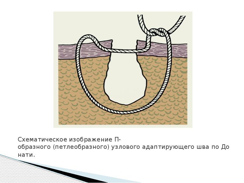 Шов донати схема