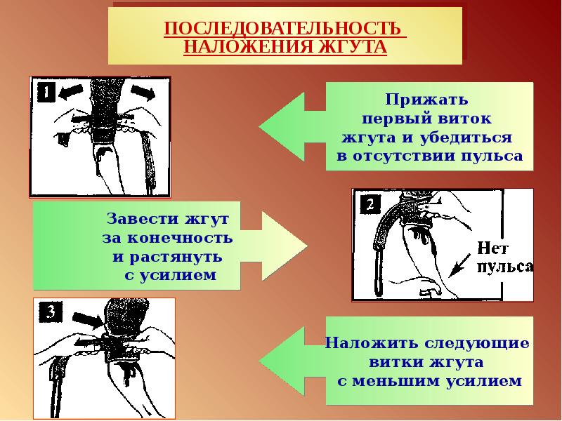 Правила наложения жгута презентация