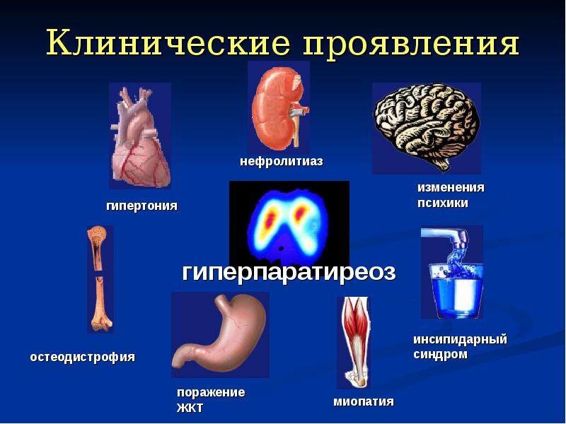 Вторичный гиперпаратиреоз презентация