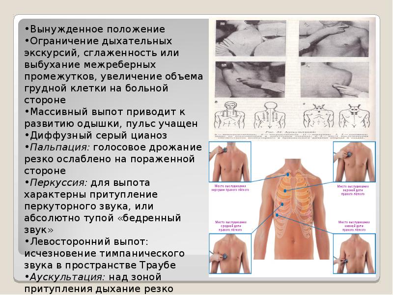 Экссудативный плеврит карта вызова