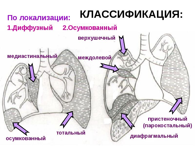 Экссудативный плеврит презентация