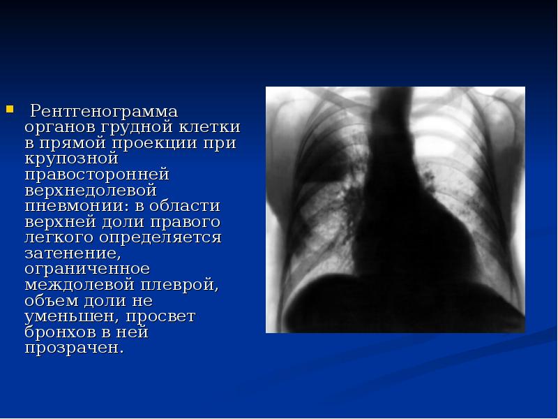 Рентгенография в прямой проекции. Описание рентгена легких при крупозной пневмонии. Рентгенограмма органов грудной клетки при крупозной. Верхнедолевая крупозная пневмония. Крупозная пневмония рентгенограмма грудной клетки.