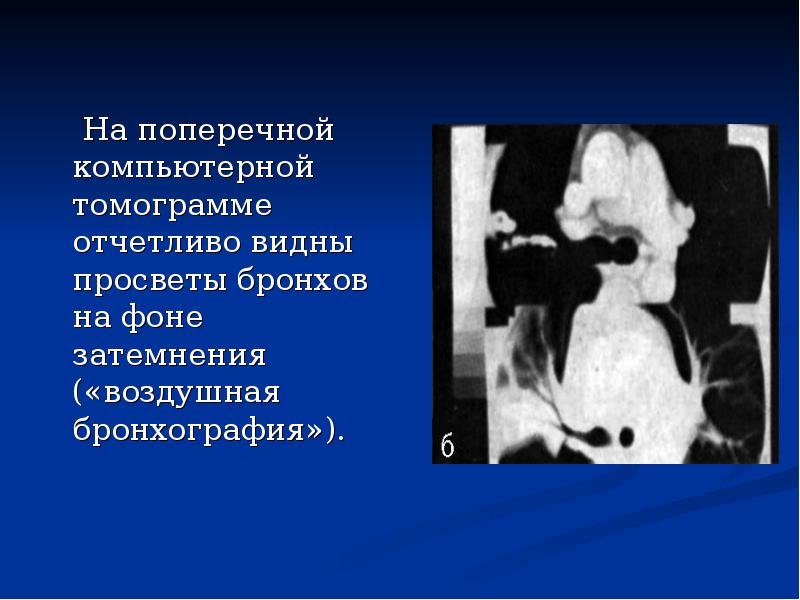 На поперечной компьютерной томограмме отчетливо видны просветы бронхов на фоне затемнения