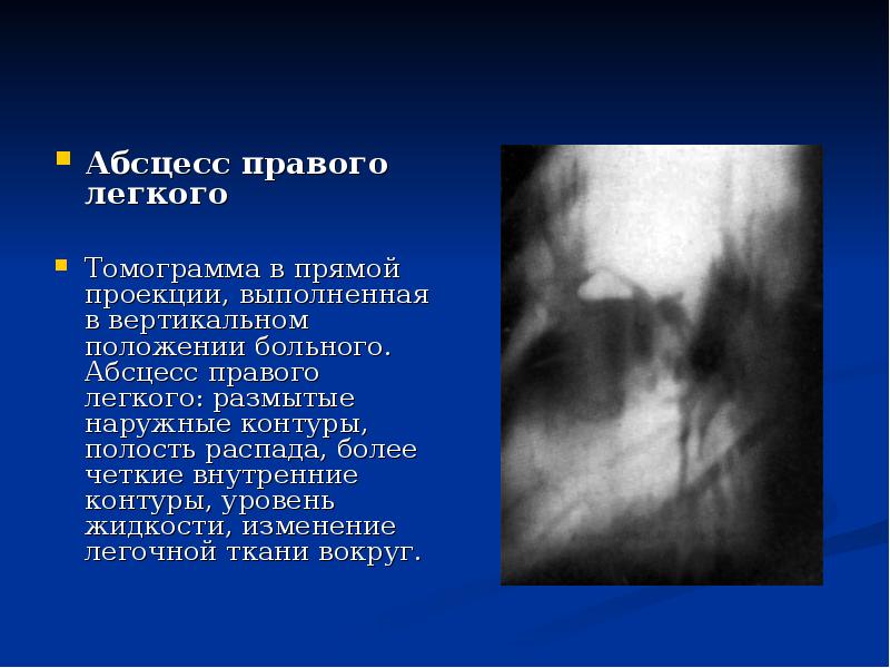 Абсцесс правого легкого    Абсцесс правого легкого  