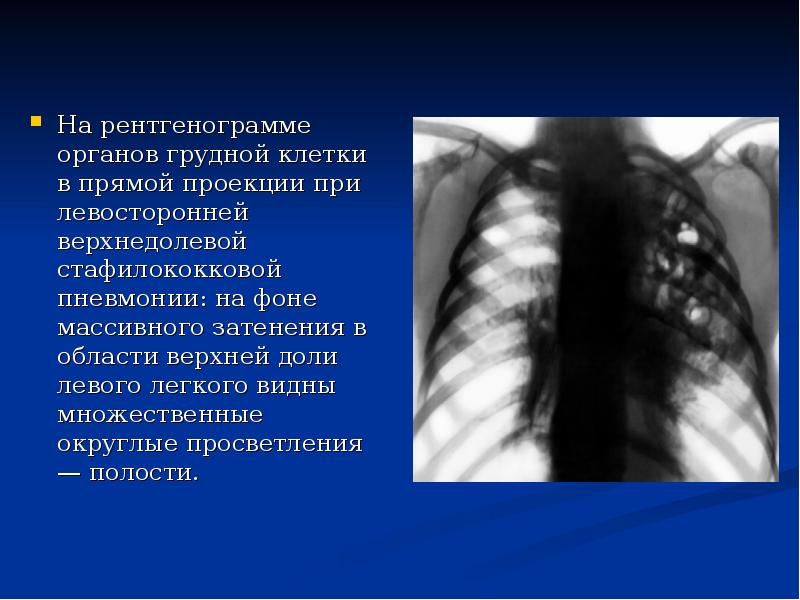 Очаговое поражение легких. Рентген органов грудной клетки пневмония. Рентгенография крупозной пневмонии. Пневмония верхней доли левого легкого рентген. Очаговая пневмония рентгенография ОГК.