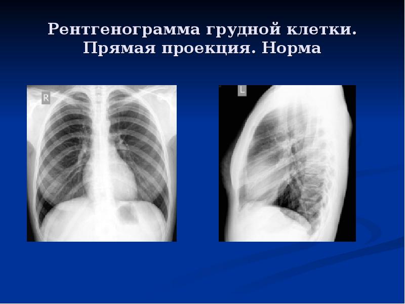 Рентгенограмма грудной клетки. Прямая проекция. Норма