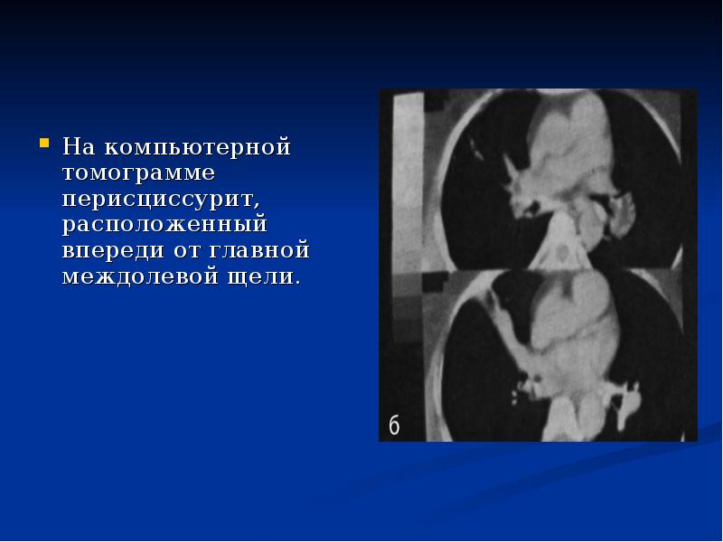 На компьютерной томограмме перисциссурит, расположенный впереди от главной междолевой щели. 