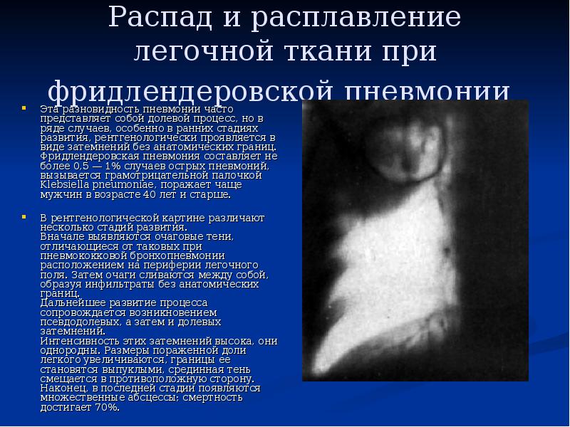 Распад и расплавление легочной ткани при фридлендеровской пневмонии  Эта разновидность