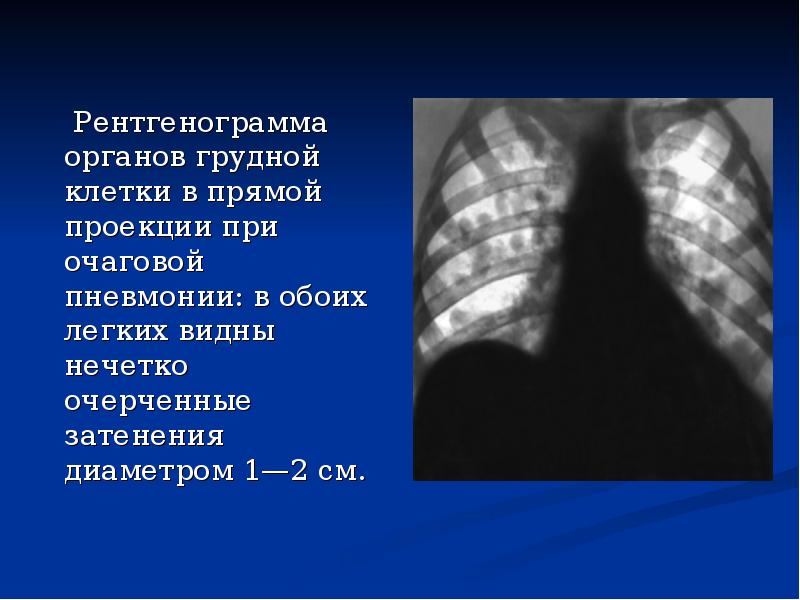 Рентгенограмма органов грудной клетки в прямой проекции при очаговой пневмонии: в